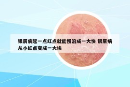 银屑病起一点红点就能慢沿成一大快 银屑病从小红点变成一大块