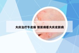 大庆治疗牛皮癣 银屑病看大庆皮肤病