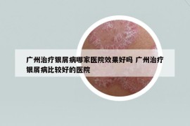 广州治疗银屑病哪家医院效果好吗 广州治疗银屑病比较好的医院