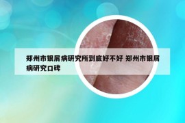 郑州市银屑病研究所到底好不好 郑州市银屑病研究口碑