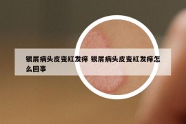 银屑病头皮变红发痒 银屑病头皮变红发痒怎么回事