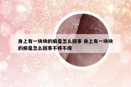 身上有一块块的癣是怎么回事 身上有一块块的癣是怎么回事不疼不痒