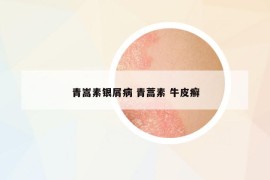 青嵩素银屑病 青蒿素 牛皮癣