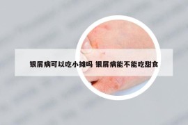 银屑病可以吃小摊吗 银屑病能不能吃甜食