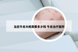 治愈牛皮大概需要多少钱 牛皮治疗医院