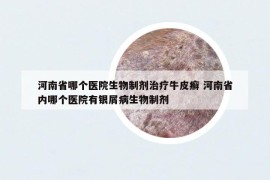 河南省哪个医院生物制剂治疗牛皮癣 河南省内哪个医院有银屑病生物制剂
