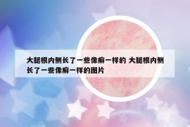大腿根内侧长了一些像癣一样的 大腿根内侧长了一些像癣一样的图片