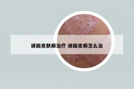 顽固皮肤癣治疗 顽固皮癣怎么治