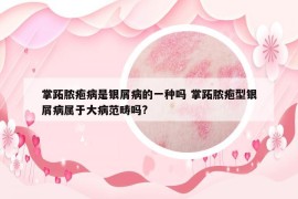 掌跖脓疱病是银屑病的一种吗 掌跖脓疱型银屑病属于大病范畴吗?