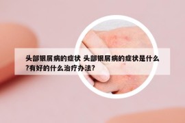 头部银屑病的症状 头部银屑病的症状是什么?有好的什么治疗办法?