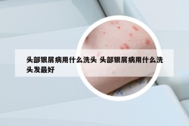 头部银屑病用什么洗头 头部银屑病用什么洗头发最好
