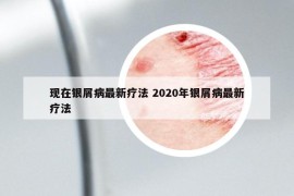 现在银屑病最新疗法 2020年银屑病最新疗法
