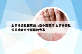血管神经性银屑病北京中医医院 血管神经性银屑病北京中医医院专家