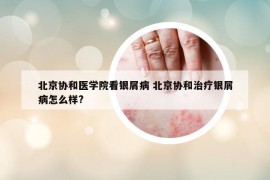 北京协和医学院看银屑病 北京协和治疗银屑病怎么样?