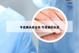 牛皮癣头皮全白 牛皮癣的头皮
