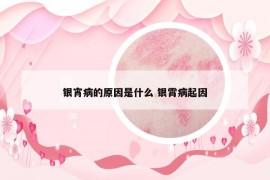 银宵病的原因是什么 银霄病起因