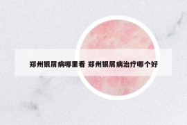 郑州银屑病哪里看 郑州银屑病治疗哪个好