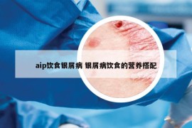 aip饮食银屑病 银屑病饮食的营养搭配