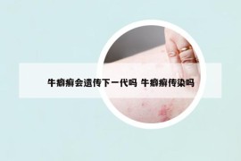 牛癖癣会遗传下一代吗 牛癖癣传染吗
