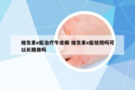 维生素e能治疗牛皮癣 维生素e能祛斑吗可以长期用吗