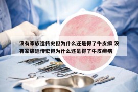 没有家族遗传史但为什么还是得了牛皮癣 没有家族遗传史但为什么还是得了牛皮癣病