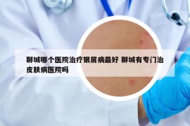 聊城哪个医院治疗银屑病最好 聊城有专门治皮肤病医院吗