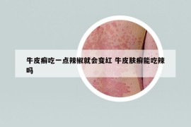 牛皮癣吃一点辣椒就会变红 牛皮肤癣能吃辣吗