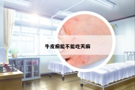 牛皮癣能不能吃天麻