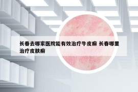 长春去哪家医院能有效治疗牛皮癣 长春哪里治疗皮肤癣