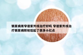 银屑病用窄谱紫外线治疗好吗 窄谱紫外线治疗银屑病照射后起了很多小红点