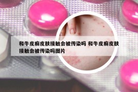 和牛皮癣皮肤接触会被传染吗 和牛皮癣皮肤接触会被传染吗图片