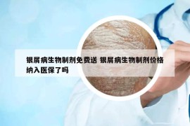 银屑病生物制剂免费送 银屑病生物制剂价格纳入医保了吗