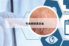 牛皮癣抹清凉油