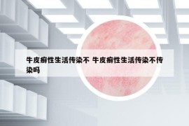 牛皮癣性生活传染不 牛皮癣性生活传染不传染吗