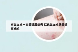 有出血点一定是银屑病吗 红色出血点就是银屑病吗