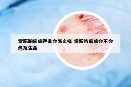 掌跖脓疱病严重会怎么样 掌跖脓疱病会不会危及生命