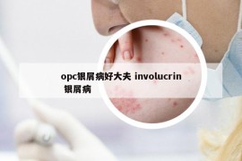 opc银屑病好大夫 involucrin 银屑病