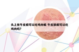 头上有牛皮癣可以吃鸡肉嘛 牛皮肤癣可以吃鸡肉吗?