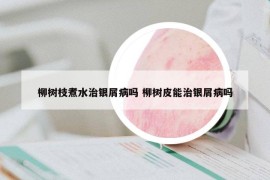 柳树枝煮水治银屑病吗 柳树皮能治银屑病吗