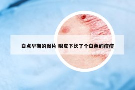 白点早期的图片 眼皮下长了个白色的痘痘