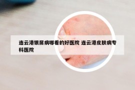 连云港银屑病哪看的好医院 连云港皮肤病专科医院