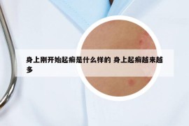 身上刚开始起癣是什么样的 身上起癣越来越多