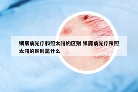 银屑病光疗和照太阳的区别 银屑病光疗和照太阳的区别是什么