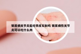 银屑病关节炎能吃铁皮石斛吗 银屑病性关节炎可以吃什么肉