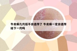 牛皮癣几代后不会遗传了 牛皮癣一定会遗传给下一代吗
