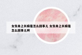 女生身上长癣是怎么回事儿 女生身上长癣是怎么回事儿啊