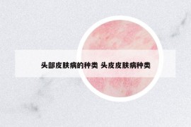 头部皮肤病的种类 头皮皮肤病种类
