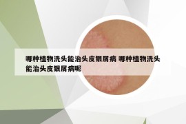 哪种植物洗头能治头皮银屑病 哪种植物洗头能治头皮银屑病呢