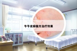 牛牛皮癣偏方治疗效果