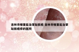吉林市哪里能治掌趾脓疱 吉林市哪里能治掌趾脓疱疹的医院